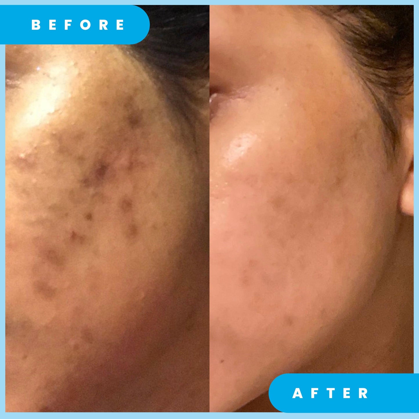 ADMIRE MY SKIN Ultra Potent Brightening Serum For Dark Spots & Uneven Skin Tone
