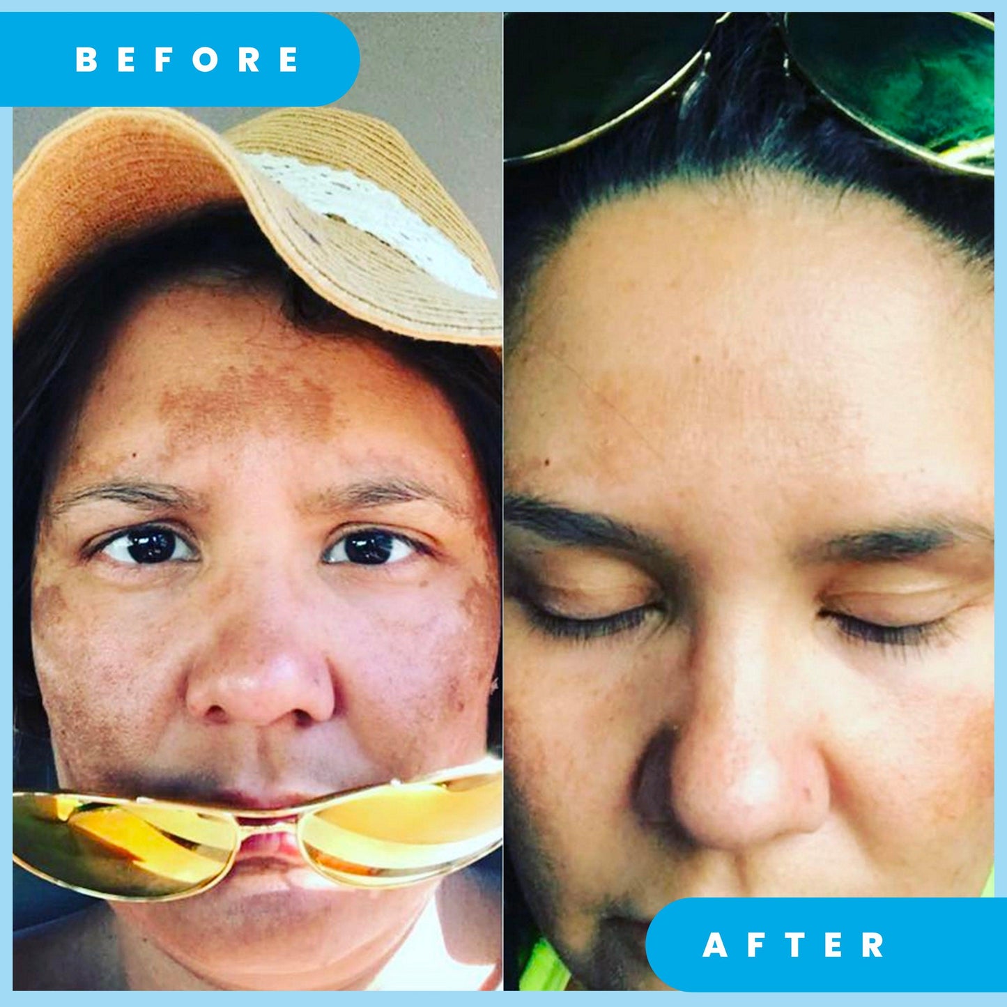 ADMIRE MY SKIN Ultra Potent Brightening Serum For Dark Spots & Uneven Skin Tone