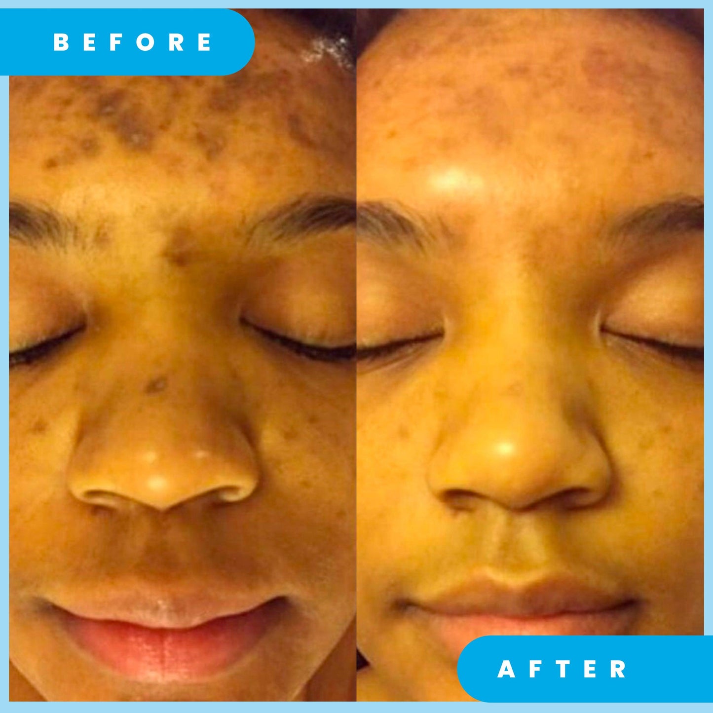 ADMIRE MY SKIN Ultra Potent Brightening Serum For Dark Spots & Uneven Skin Tone