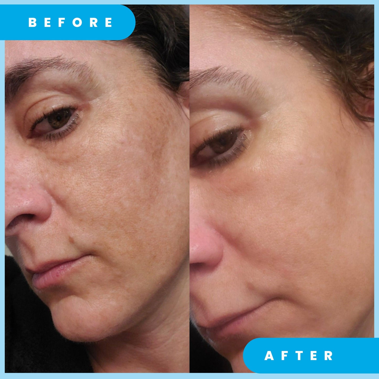 ADMIRE MY SKIN Ultra Potent Brightening Serum For Dark Spots & Uneven Skin Tone