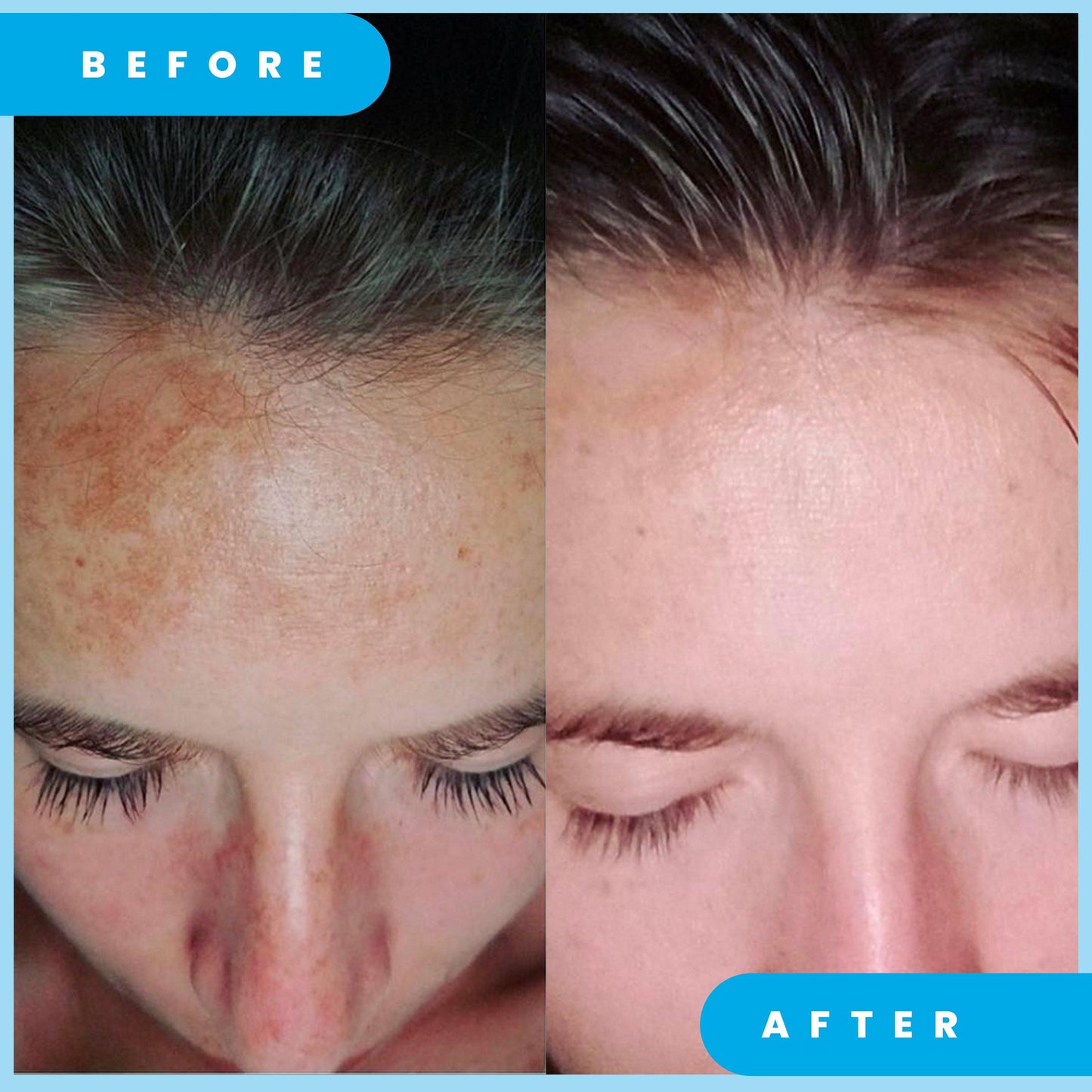 ADMIRE MY SKIN Ultra Potent Brightening Serum For Dark Spots & Uneven Skin Tone