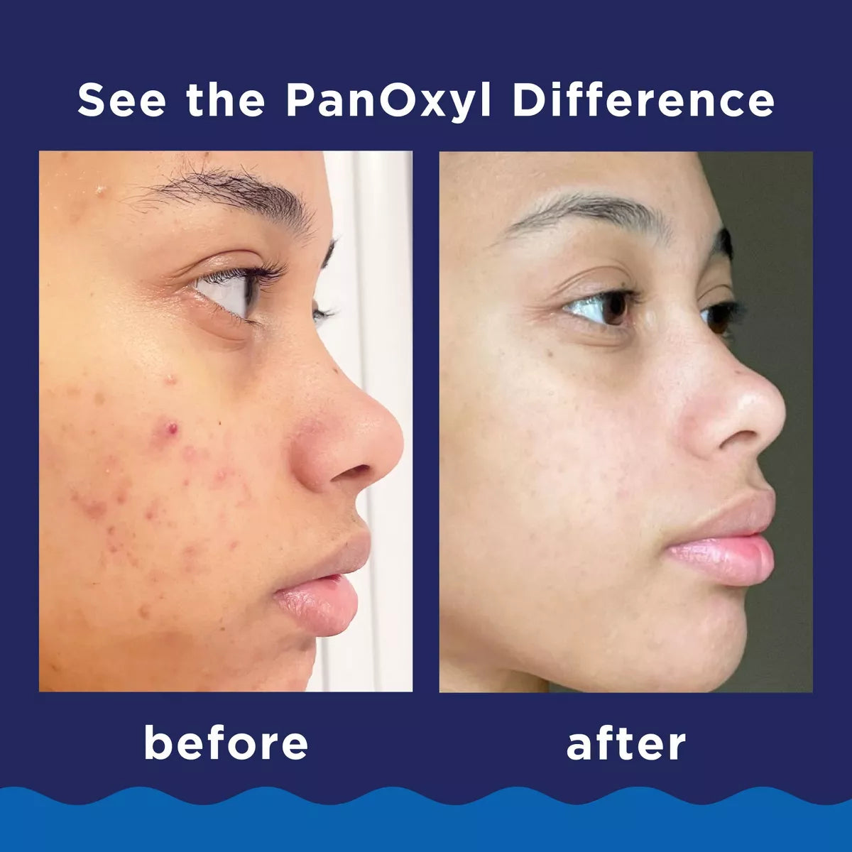 PANOXYL 10% Acne Foaming Wash 5.5oz